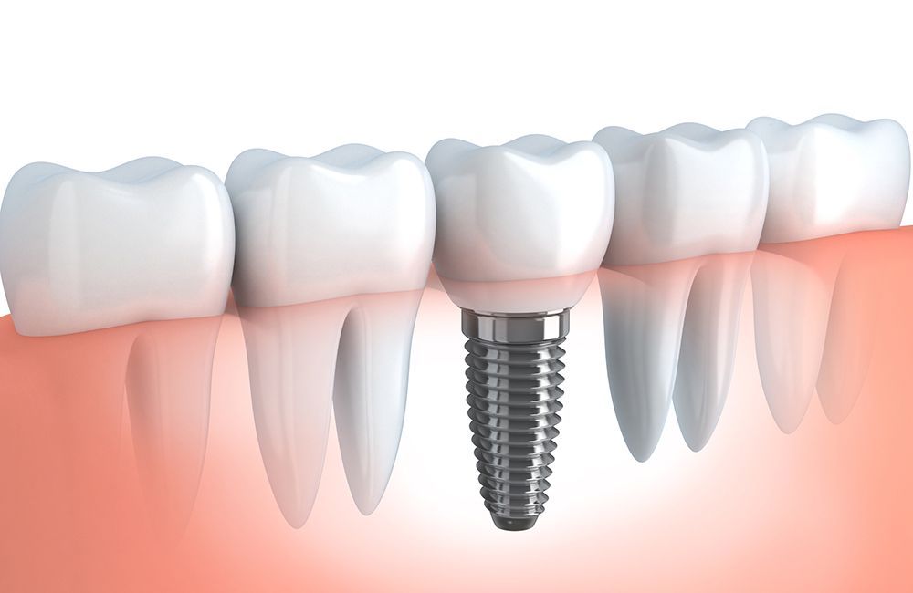 rodzaje implantów w stomatologii - wiedza - blog - klinika stomatologiczna Poznań Materna Dental