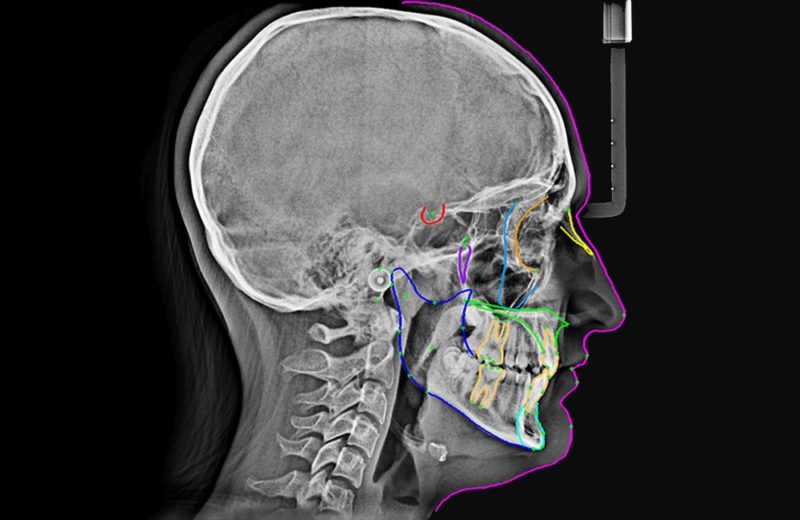 Radiologia stomatologiczna - Rentgen zębów - RTG zęba- Materna DENTAL ...