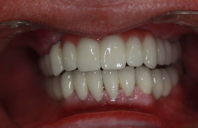 swiss implant systems - zastosowanie wielu implantów - 3 - klinika stomatologiczna poznań materna dental