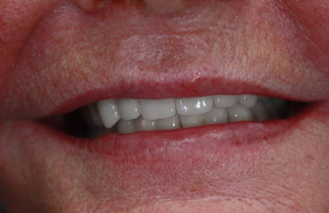 swiss implant systems - zastosowanie wielu implantów - 4 - klinika stomatologiczna poznań materna dental