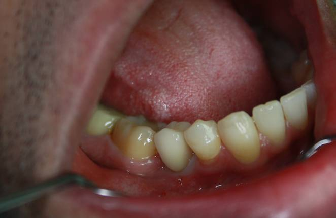 swiss implant systems - zastosowanie jednego implantu - 4 - klinika stomatologiczna poznań materna dental