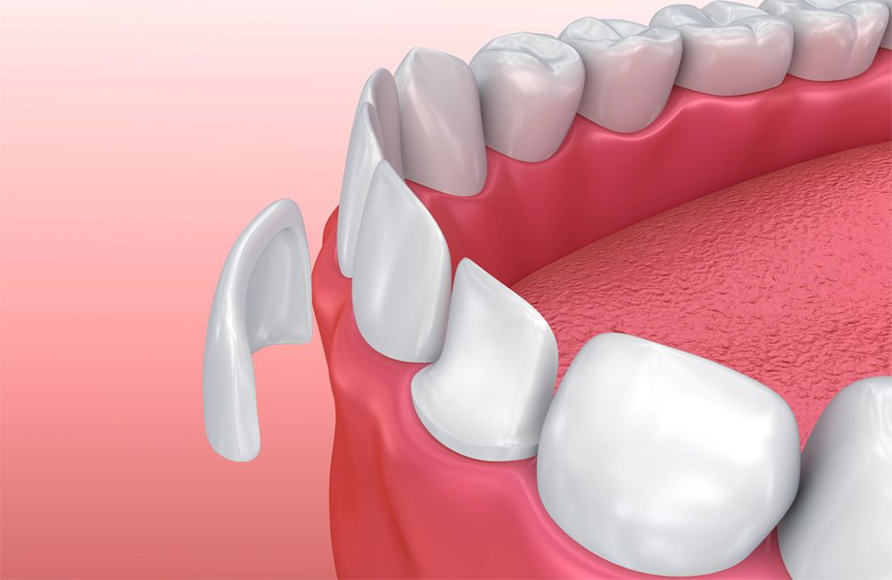 korony porcelanowe - klinika stomatologiczna poznań materna dental