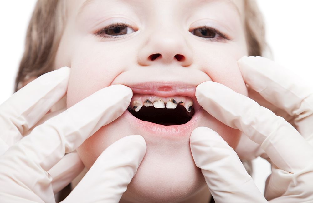 próchnica zębów - klinika stomatologiczna poznań materna dental