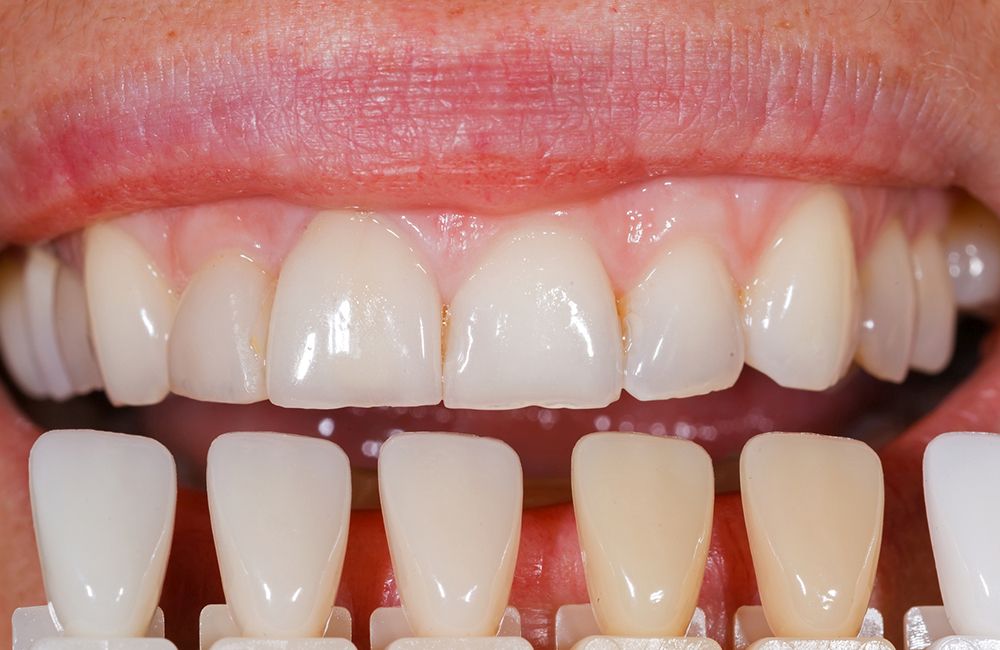 licówki porcelanowe - klinika stomatologiczna poznań materna dental