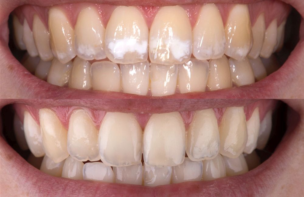 usuwanie białych plamek - metoda infiltracji - klinika stomatologiczna poznań materna dental