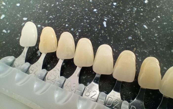 dlaczego zęby ciemnieją? Krótka historia o odcieniach bieli - wiedza - blog - klinika stomatologiczna Poznań Materna Dental