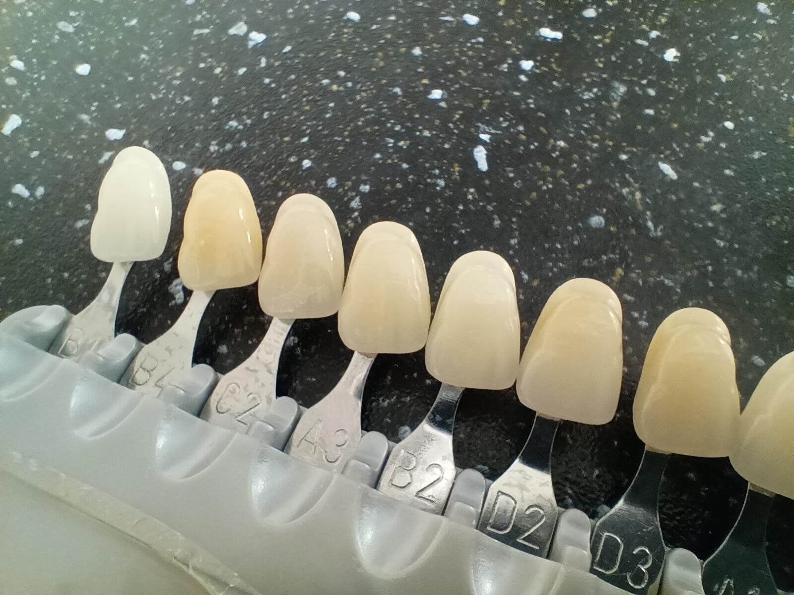 dlaczego zęby ciemnieją? Krótka historia o odcieniach bieli - wiedza - blog - klinika stomatologiczna Poznań Materna Dental