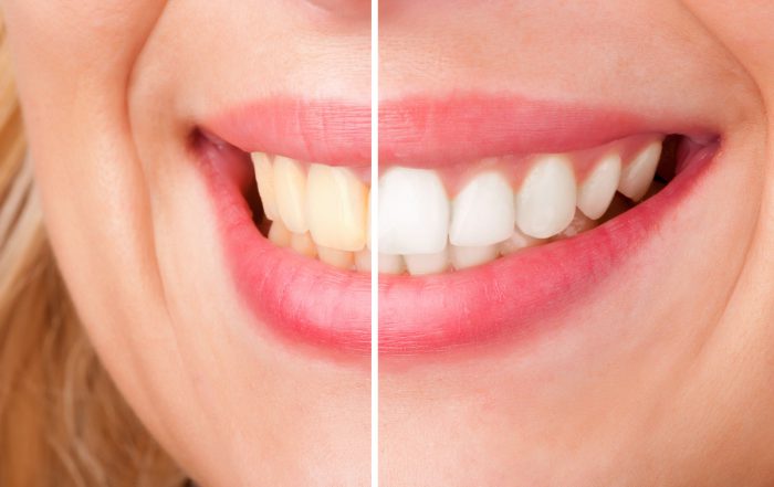 wybielanie zębów - co wybrać? - wiedza - blog - klinika stomatologiczna Poznań Materna Dental