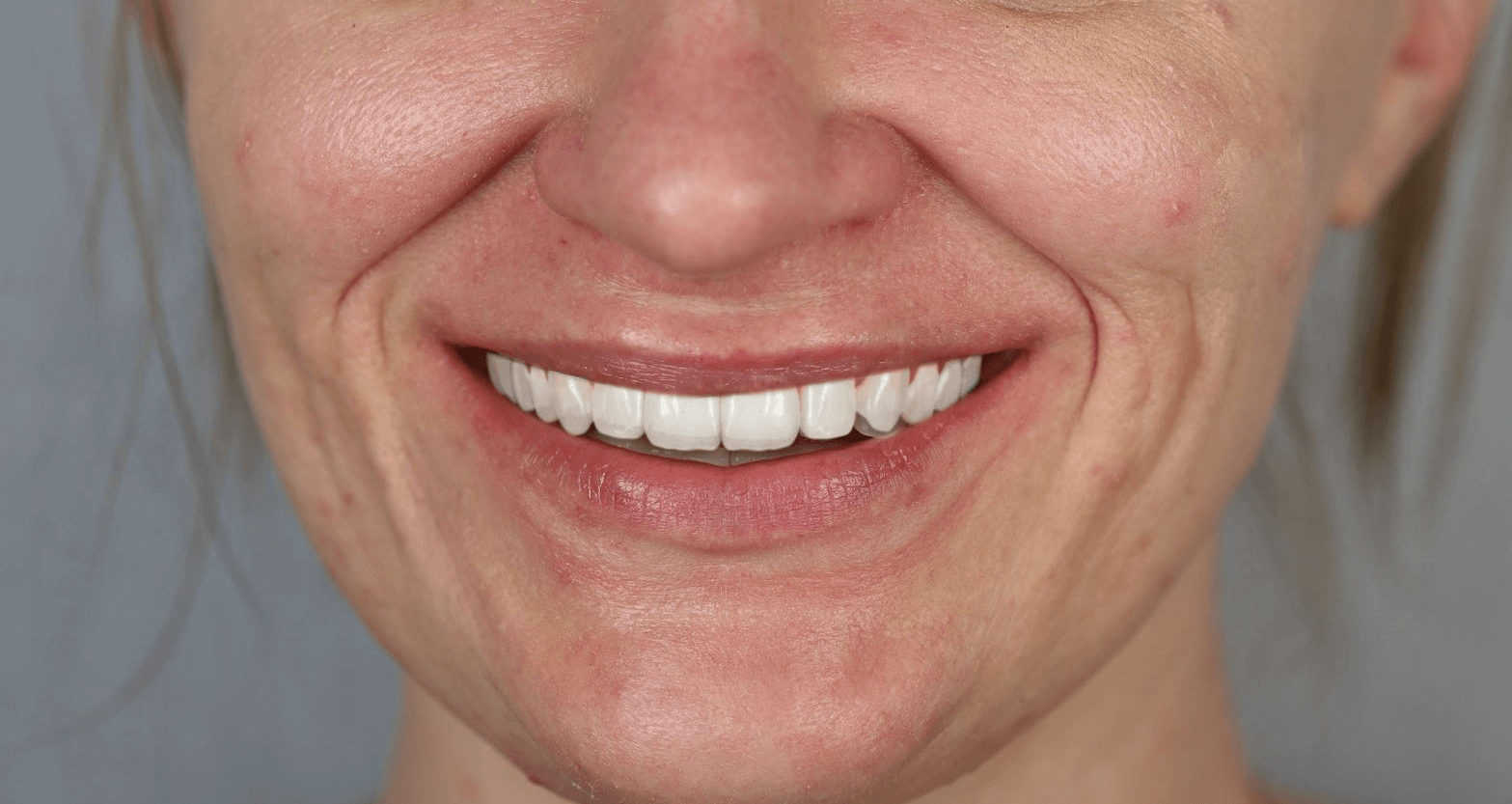 projektowanie uśmiechu - gotowy projekt z wybranymi zębami z bibliotek programu - wiedza - blog - klinika stomatologiczna Poznań Materna Dental