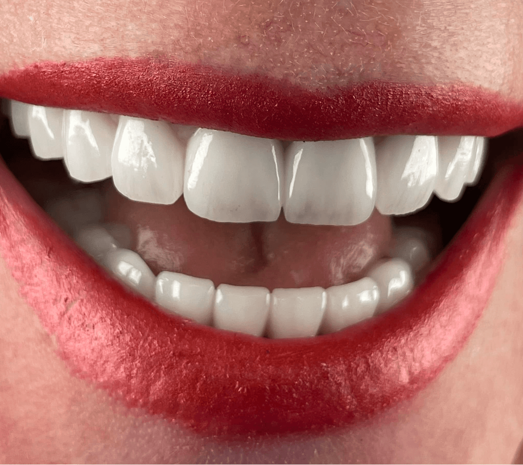 projektowanie uśmiechu - korony Lava - wiedza - blog - klinika stomatologiczna Poznań Materna Dental