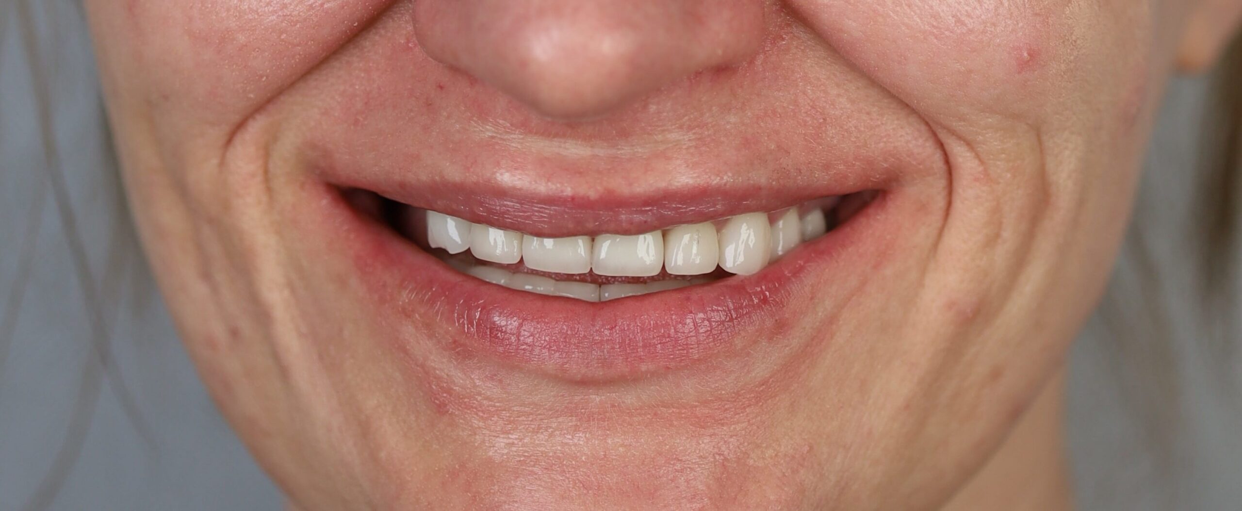 projektowanie uśmiechu - przybliżenie uśmiechu - wiedza - blog - klinika stomatologiczna Poznań Materna Dental