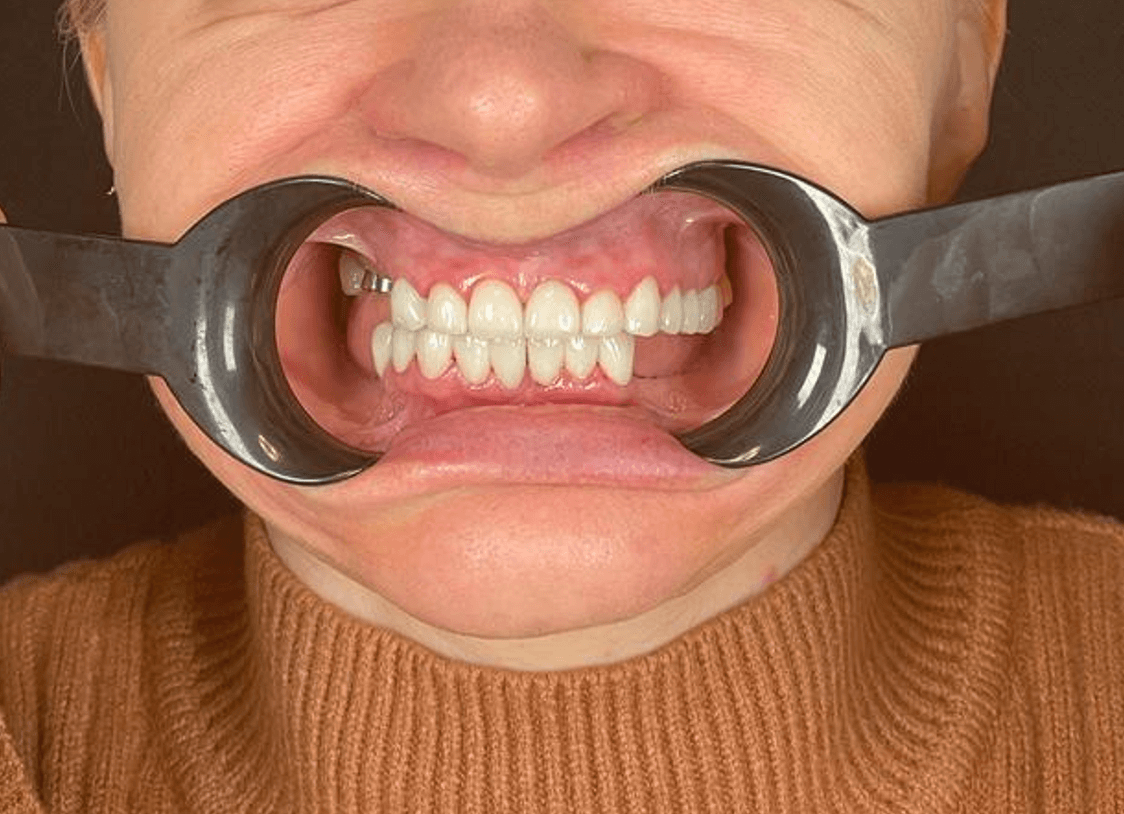 projektowanie uśmiechu - zdjęcie pacjentki przed leczeniem - wiedza - blog - klinika stomatologiczna Poznań Materna Dental