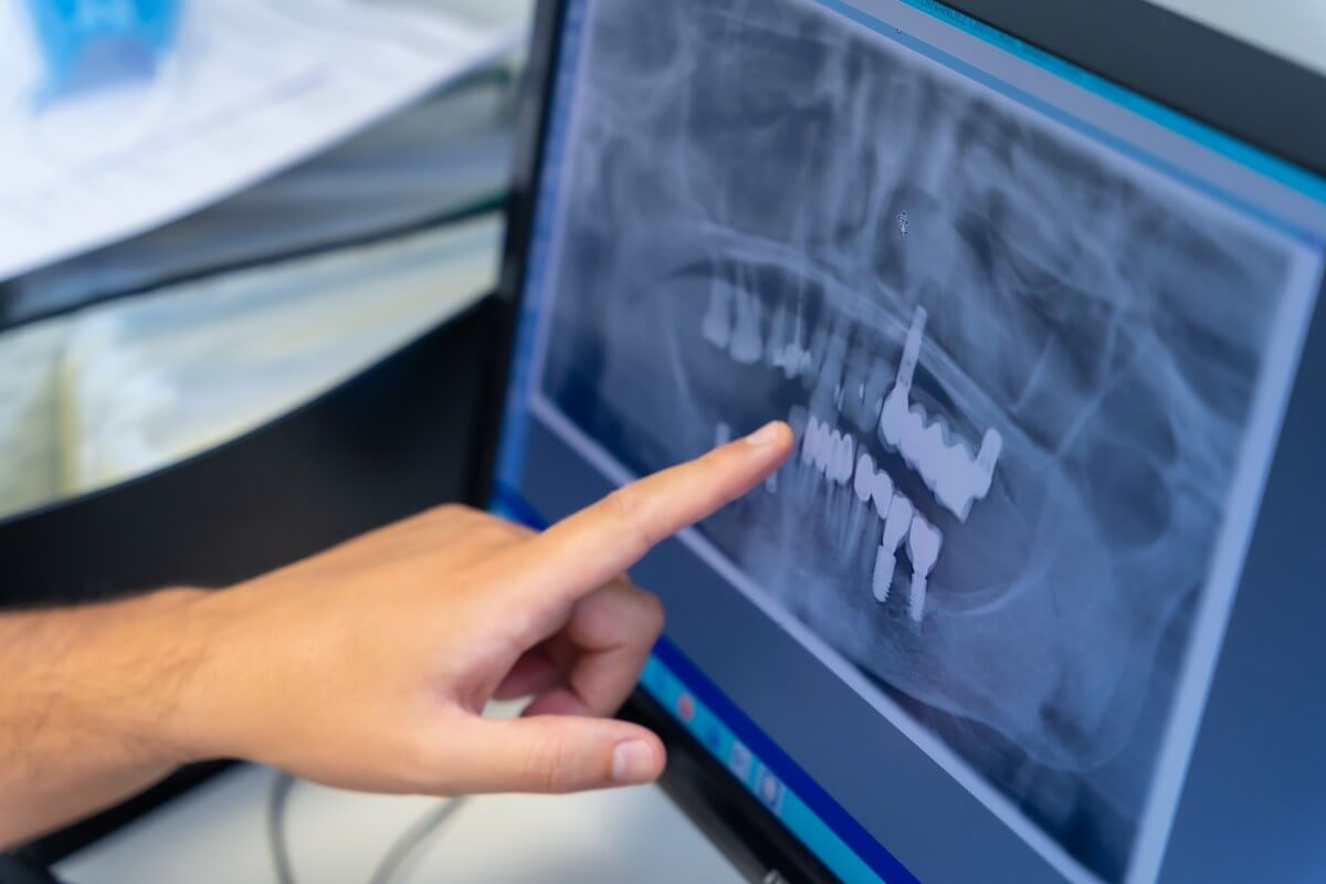 implanty - konsultacja implantologiczna - wiedza - blog - klinika stomatologiczna Poznań Materna Dental