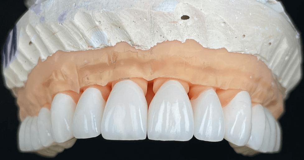 usmiech-lava-model-klinika-stomatologiczna-poznan-materna-dental