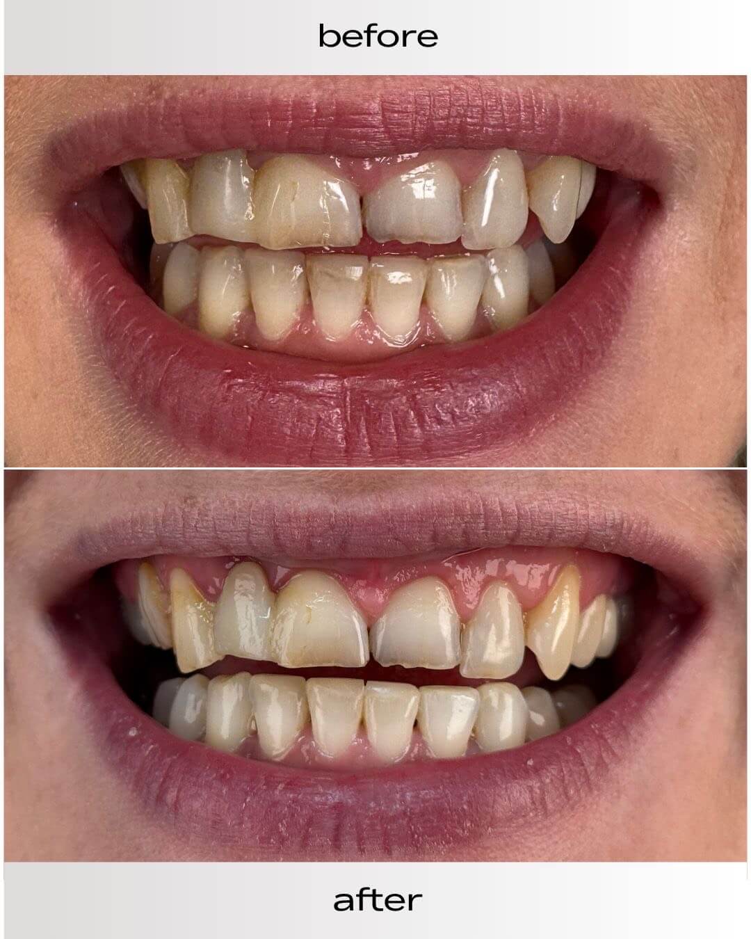 maternadental.pl-sprzet-gingiwektomia-efekt-przed-i-po