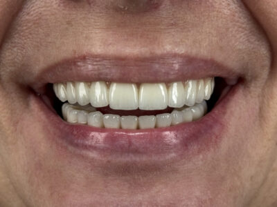 odbudowa-protetyczna-na-4-implantach-materna-dental-poznan-9-efekt-koncowy