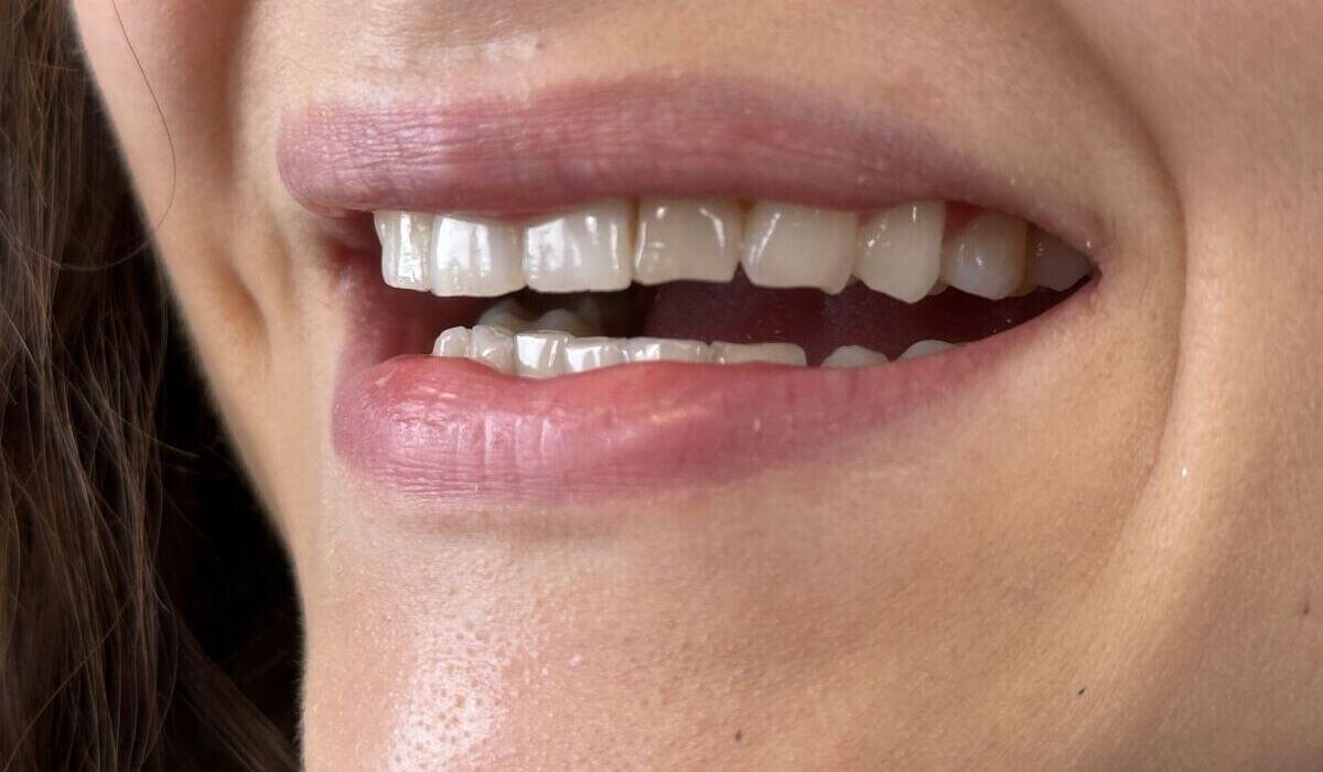 flow-injection-i-korony-pelnoceramiczne-pelnokonturowe-materna-dental-poznan-przed-2