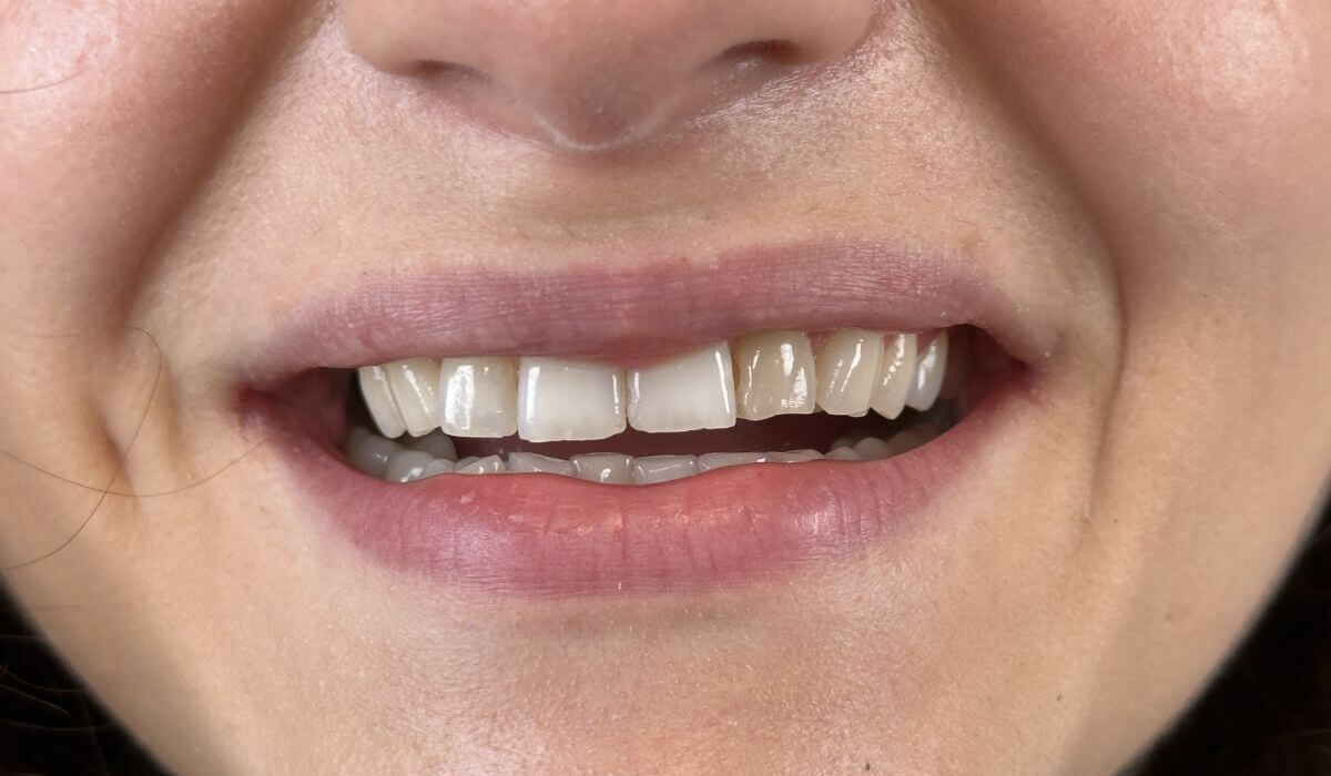flow-injection-i-korony-pelnoceramiczne-pelnokonturowe-materna-dental-poznan-przed-3