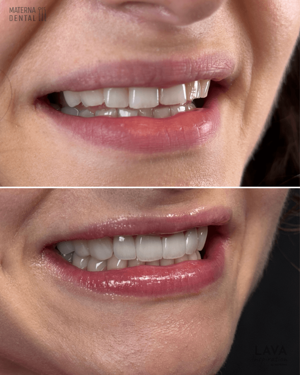 flow-injection-i-korony-pelnoceramiczne-pelnokonturowe-materna-dental-poznan-przed-4