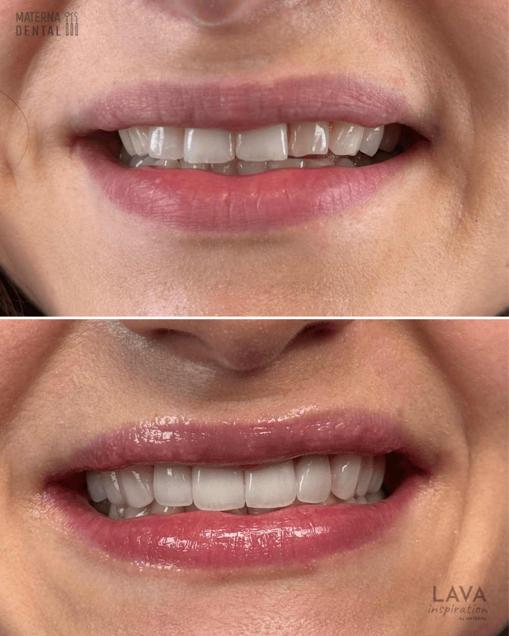 flow-injection-i-korony-pelnoceramiczne-pelnokonturowe-materna-dental-poznan-przed-5