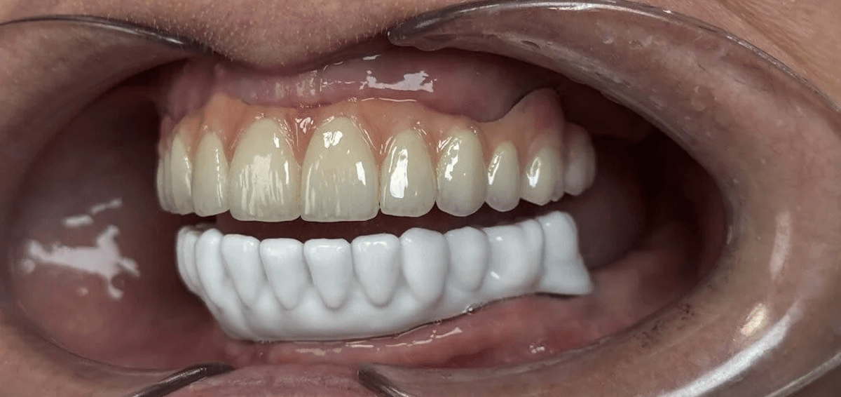 odbudowa-protetyczna-na-4-implantach-materna-dental-poznan-praca-w-gornym-CAST-7a
