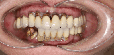 odbudowa-protetyczna-na-4-implantach-materna-dental-poznan-przed-1