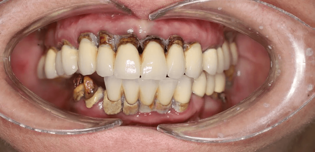 odbudowa-protetyczna-na-4-implantach-materna-dental-poznan-przed-1