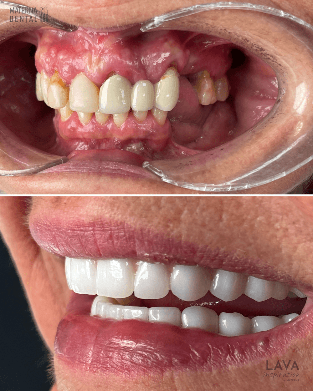 praca-protetyczna-na-6-implantach-materna-dental-poznan-6