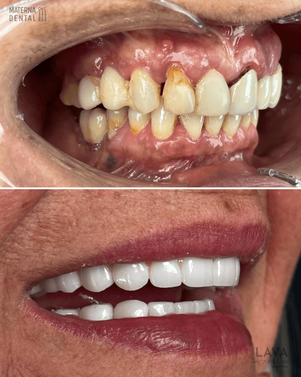 praca-protetyczna-na-6-implantach-materna-dental-poznan-8